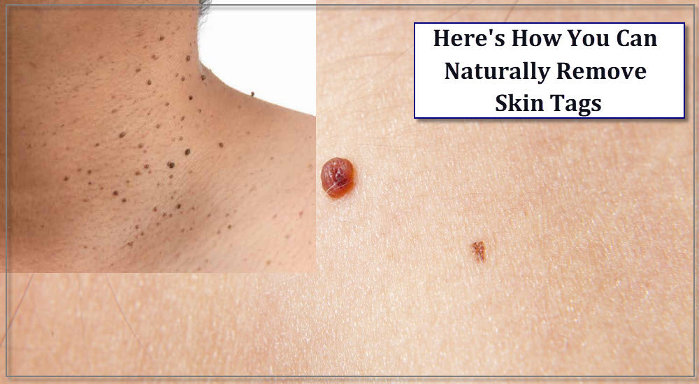 Here's How You Can Naturally Remove Skin Tags