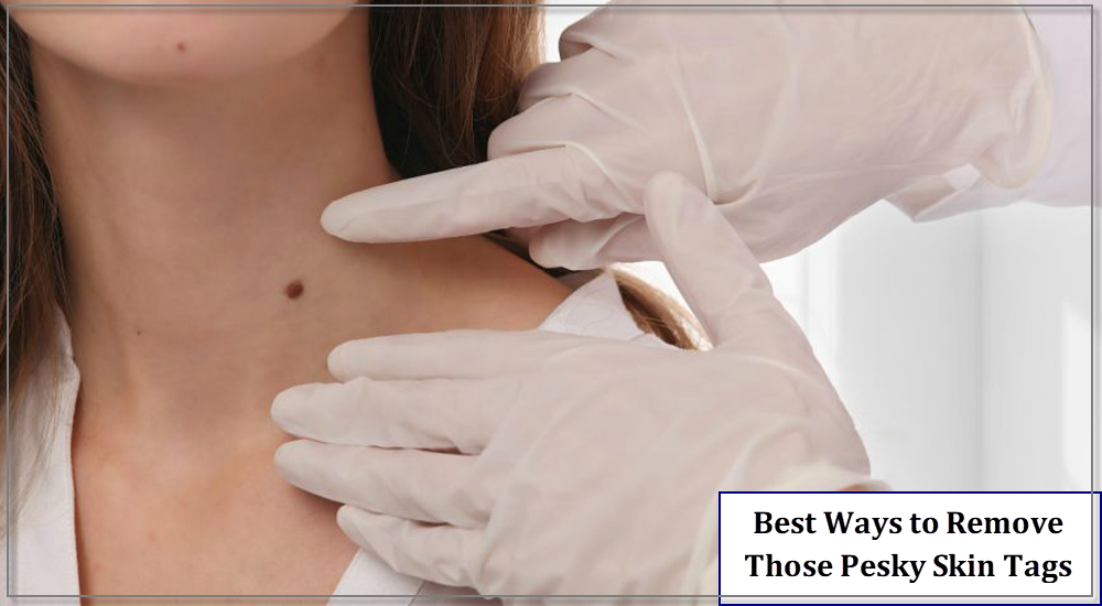 Best Options for Removing Those Pesky Skin Tags