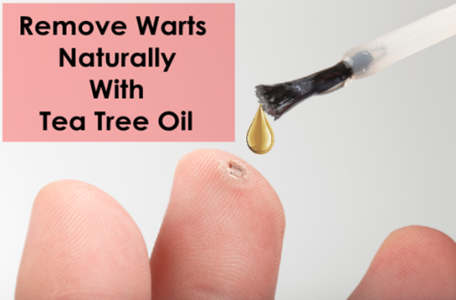 Remove Those Nasty Warts with Tea Tree Oil